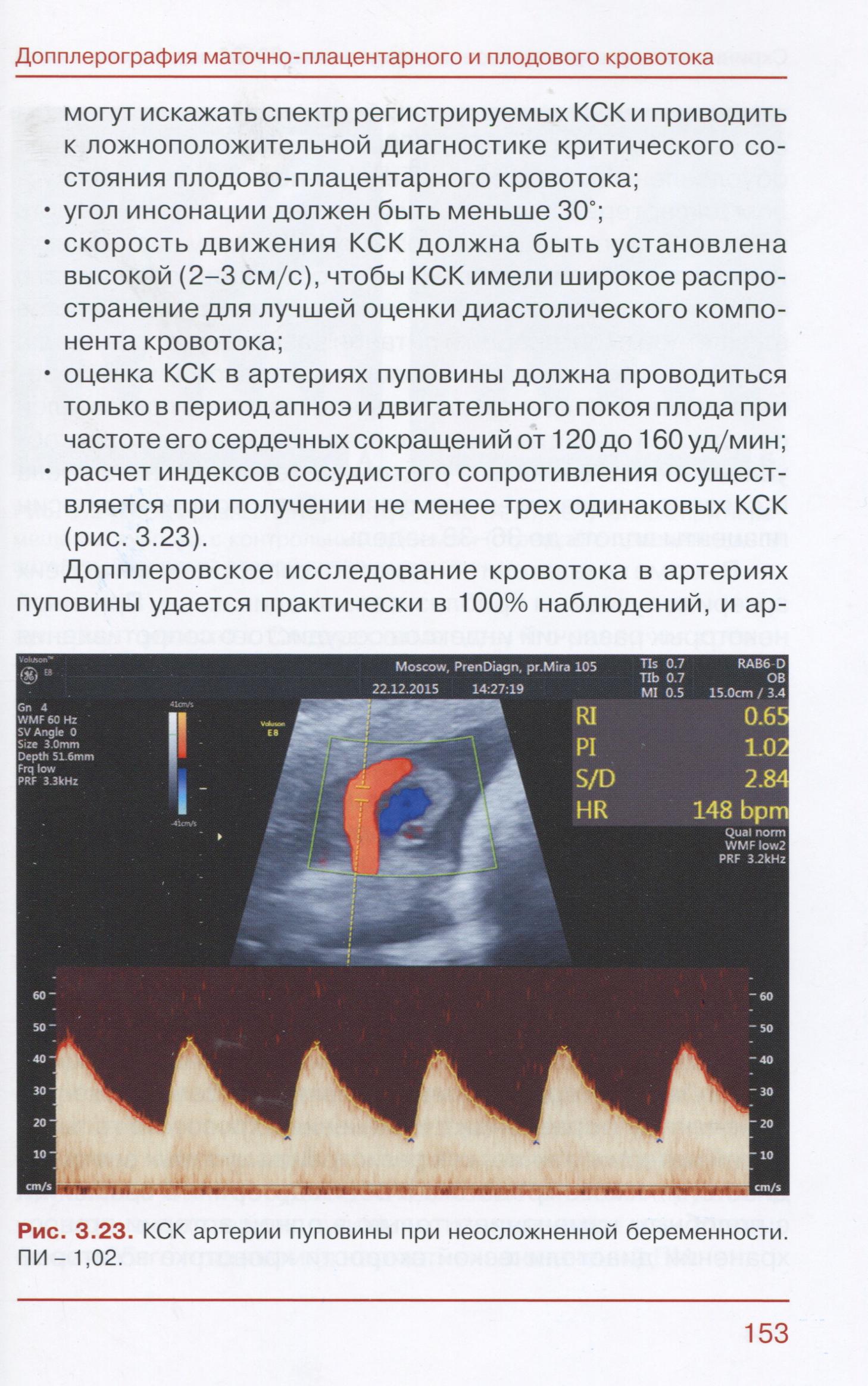 Рис. 3.23. КСК артерии пуповины при неосложненной беременности. ПИ - 1,02.